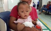 Những ngón dần hình thành trên bàn tay dị dạng của cô bé 17 tuổi Những ngón dần hình thành trên bàn tay dị dạng của cô bé 17 tuổi