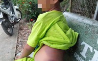 Học sinh lớp 1 bị cô giáo đánh bầm người Học sinh lớp 1 bị cô giáo đánh bầm người