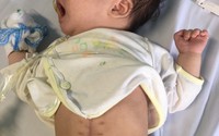 Xót lòng bé sơ sinh bục dạ dày 15cm, 2 tháng tuổi đã 3 lần phẫu thuật Xót lòng bé sơ sinh bục dạ dày 15cm, 2 tháng tuổi đã 3 lần phẫu thuật