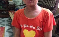 Bệnh tình của cậu bé sống đơn côi bị lở loét khắp người ngày càng thêm trầm trọng Bệnh tình của cậu bé sống đơn côi bị lở loét khắp người ngày càng thêm trầm trọng
