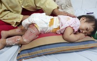 Ngã vào nồi canh, bé gái 16 tháng tuổi bị bỏng nặng, chỉ có thể nằm sấp và khóc Ngã vào nồi canh, bé gái 16 tháng tuổi bị bỏng nặng, chỉ có thể nằm sấp và khóc