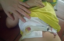 Xót xa cô bé 5 tuổi trải qua 11 lần phẫu thuật mà chưa 1 ngày được đi vệ sinh bình thường Xót xa cô bé 5 tuổi trải qua 11 lần phẫu thuật mà chưa 1 ngày được đi vệ sinh bình thường