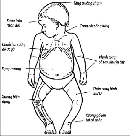
Các biến chứng do còi xương ở trẻ em.
