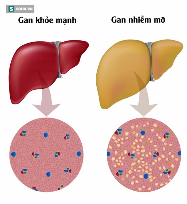 5 món trà dễ làm giải độc gan, tiêu mỡ gan hiệu quả