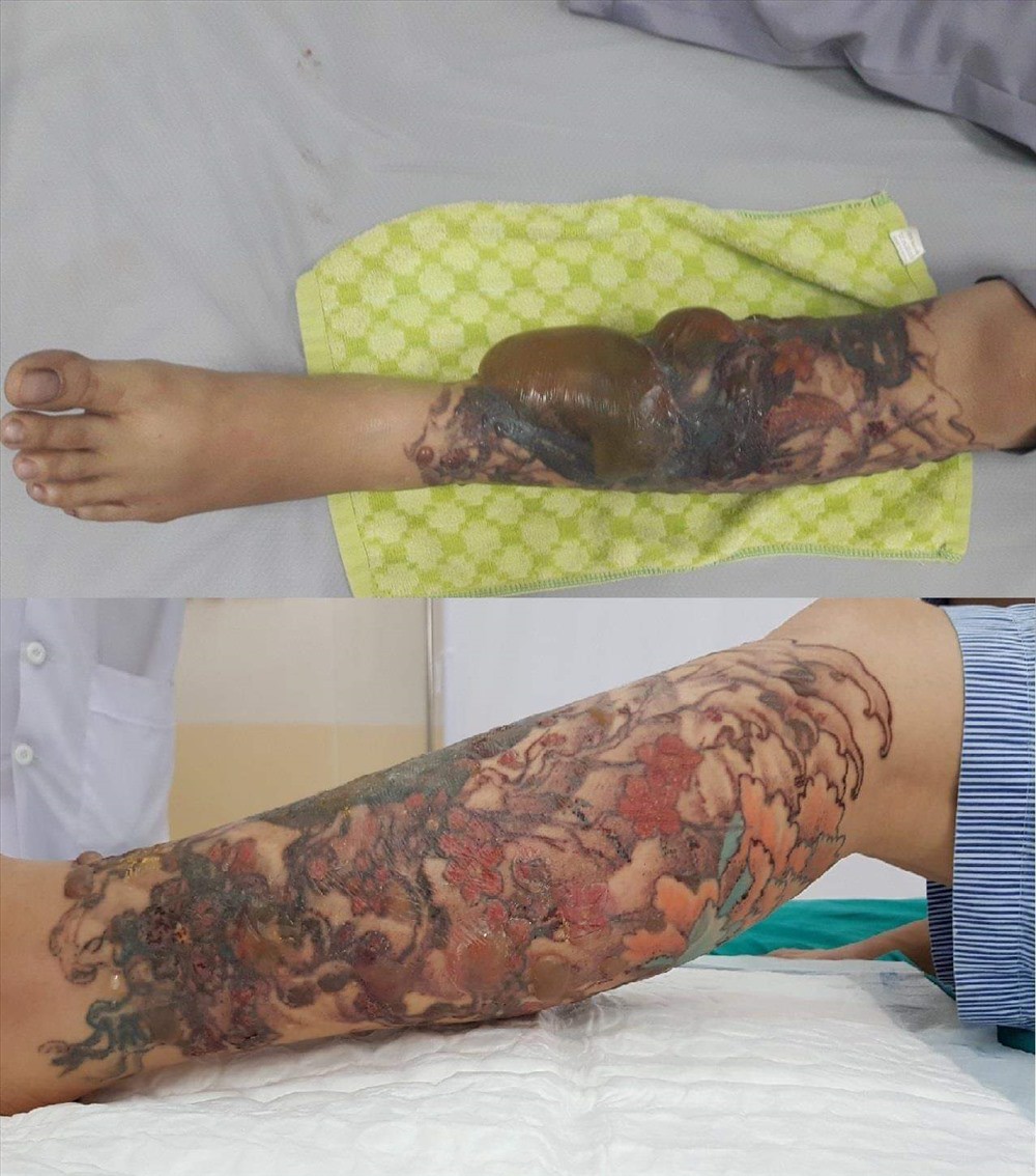 Hình ảnh vùng da bị bong tróc và kích ứng sau khi xăm thể hiện phản ứng dị ứng với mực xăm
