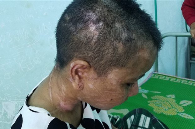 Y Nhiêu bị Hà tra tấn, hành hạ suốt 1 thời gian dài. Ảnh: Dân Trí.