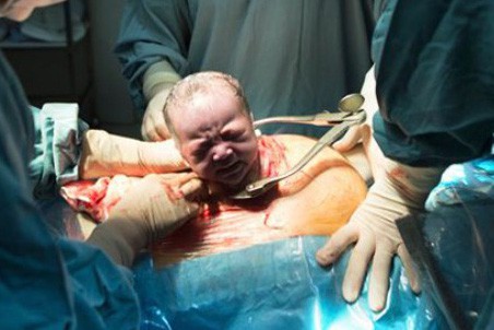 Chứng kiến quá trình gây tê tủy sống trước khi sinh mổ, chị em bảo nhau: “Thôi cố gắng đẻ thường!”