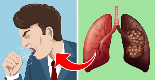 5 dấu hiệu của bệnh ung thư phổi nhiều người thường bỏ qua