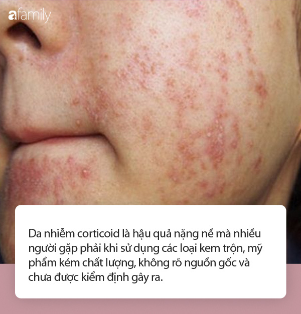 Kem trộn: T&aacute;c nh&acirc;n kinh ho&agrave;ng khiến da mặt bị nhiễm corticoid bị tổn thương nghi&ecirc;m trọng, m&agrave;i m&ograve;n, vi&ecirc;m nhiễm m&atilde;n t&iacute;nh