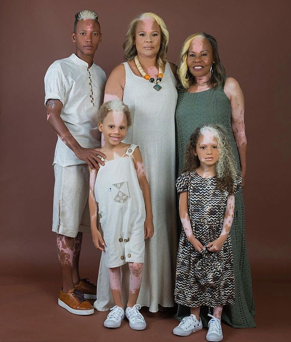 Gia đình ba thế hệ cùng có mảng da tóc màu lạ