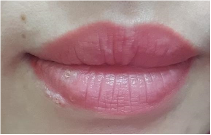 Xăm môi được 3 ngày thì bị mụn rộp herpes ở môi, 2 tuần sau tổn thương toàn thân: 3 nguy cơ có thể gặp sau khi phun xăm bác sĩ muốn mọi người cần biết  - Ảnh 1.
