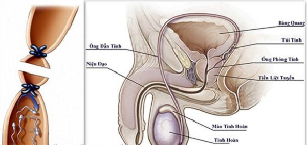  Thắt ống dẫn tinh - Biện pháp tránh thai hiệu quả, ít rủi ro  - Ảnh 1.