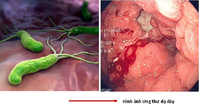  Ung thư dạ dày: Bằng cách nào để phát hiện ra ở giai đoạn sớm? - Ảnh 2.