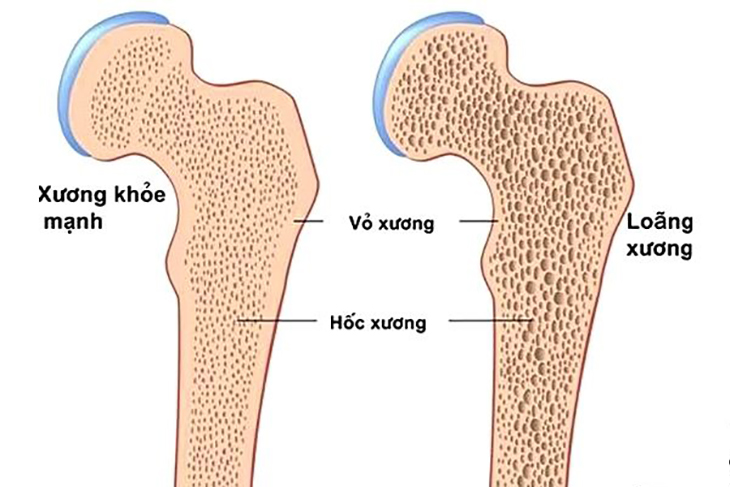 Dinh dưỡng đúng cách giúp phòng ngừa và cải thiện loãng xương - Ảnh 2.