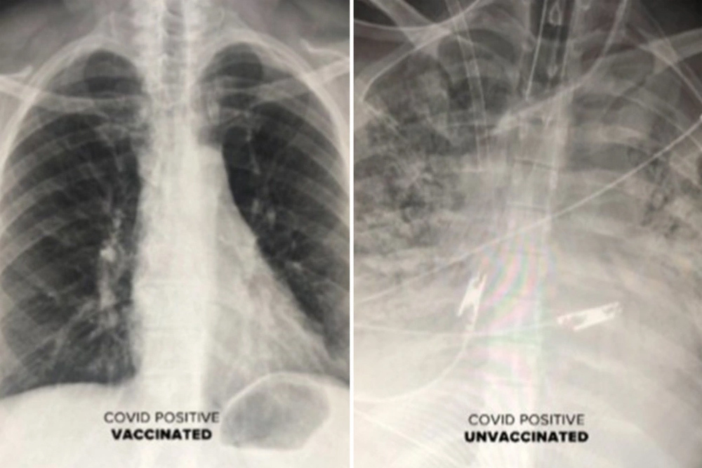 Khác biệt giữa phổi người bệnh Covid-19 đã tiêm vắc xin và chưa tiêm - Ảnh 1.