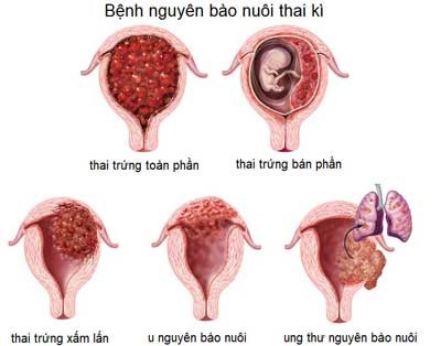 Chậm kinh, kèm cảm giác ốm nghén, người phụ nữ U50 bất ngờ phát hiện chửa trứng  - Ảnh 1.