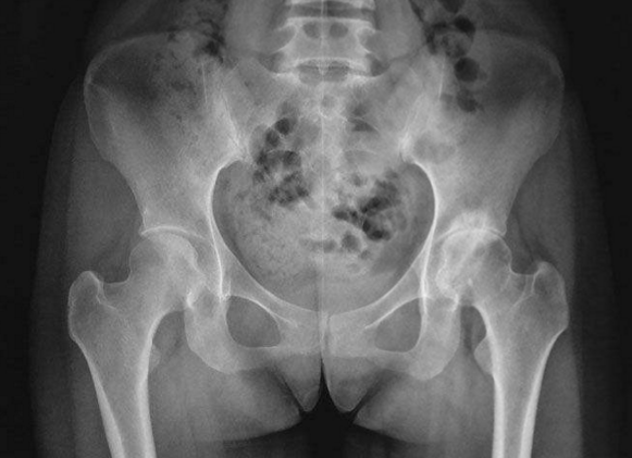 C&ocirc; g&aacute;i bị đau lưng kh&ocirc;ng ngủ được, kh&aacute;m thấy xương thủng như tổ ong, tất cả l&agrave; do 1 loại nước nhiều người y&ecirc;u th&iacute;ch - Ảnh 2.