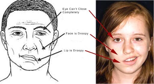 C&ocirc; g&aacute;i B&igrave;nh Thuận bị m&eacute;o miệng, liệt nửa mặt v&igrave; một th&oacute;i quen ăn uống h&agrave;ng triệu người trẻ đang c&oacute;, ngoại h&igrave;nh sau khi can thiệp thẩm mỹ thực sự đ&aacute;ng kinh ngạc - Ảnh 3.