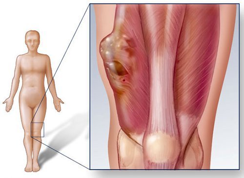 Từ tai nạn ngã xe máy nhẹ nhàng, nam sinh 17 tuổi phát hiện ra căn bệnh ung thư giai đoạn cuối - Ảnh 1.