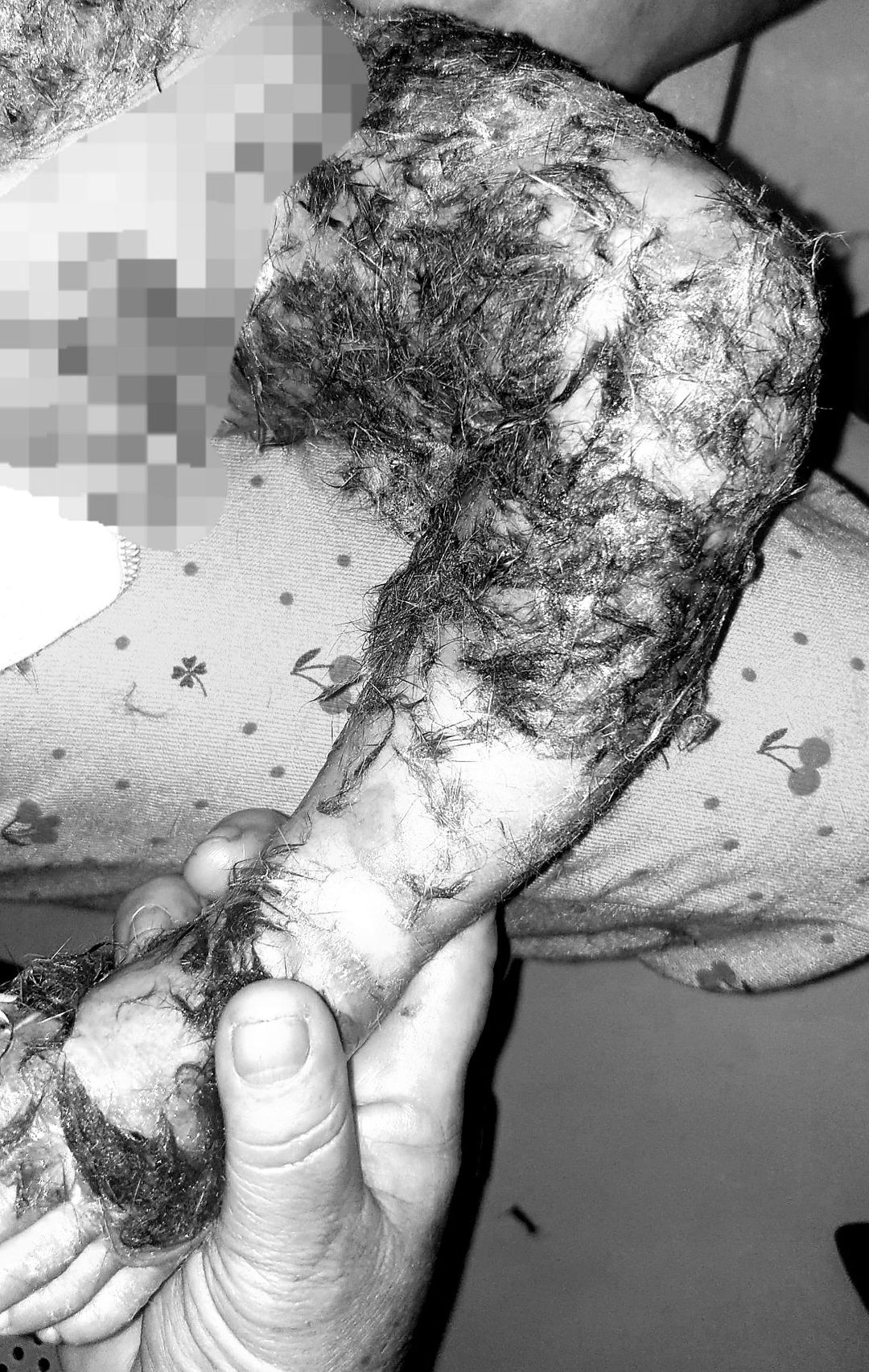 Thầy lang đắp lông chó để chữa bỏng cho bé 8 tháng tuổi khiến nguy cơ nhiễm trùng