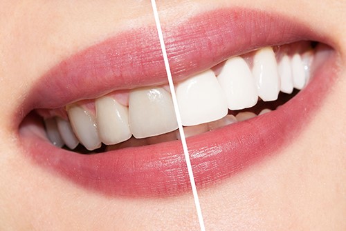 5 thói quen tàn phá răng lợi của bạn, không muốn hỏng răng sớm cần tránh ngay - Ảnh 4.