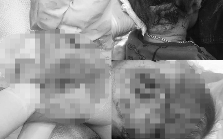 Kinh hoàng chó dữ lao vào tấn công bé trai 2 tuổi ở Tuyên Quang