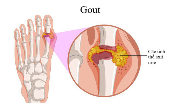 Người mắc bệnh gút nên kiêng gì? - Ảnh 2.