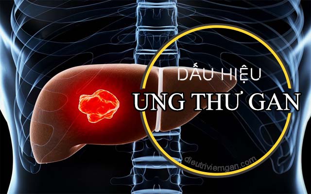 8 thay đổi nhỏ nhưng là dấu hiệu cảnh báo ung thư gan, kiểm tra ngay nếu có cần được khám sớm - Ảnh 2.