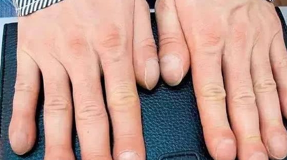 Sưng ngón tay, người phụ nữ đi khám mới biết bị ung thư phổi: Cảnh báo 2 dấu hiệu khi bệnh khởi phát, làm tốt 3 việc bệnh không dám đến gần - Ảnh 2.