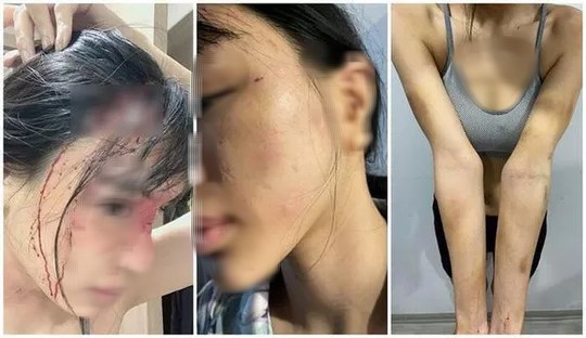 Điều tra vụ siêu mẫu Khả Trang 'tố' chồng chưa cưới hành hung