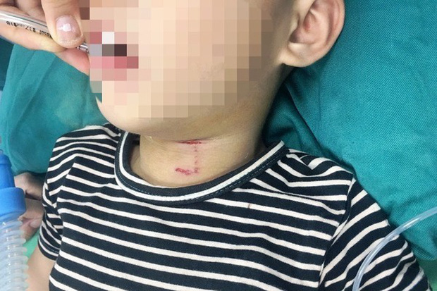Nghệ An: Bé trai 3 tuổi bị chó cắn rách vùng cổ, thủng khí quản - Ảnh 2.