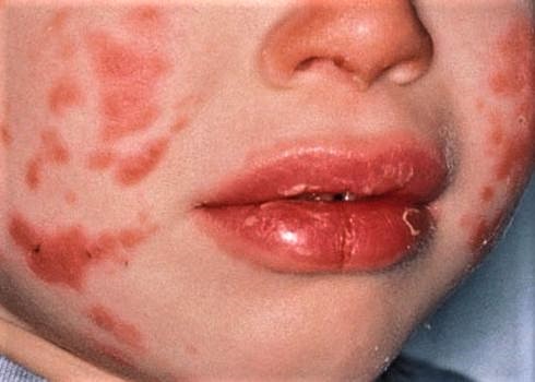 Bé 3 tuổi ở Hà Nội phát hiện mắc bệnh KAWASAKI nguy hiểm khi sốt cao vài ngày - Ảnh 3.