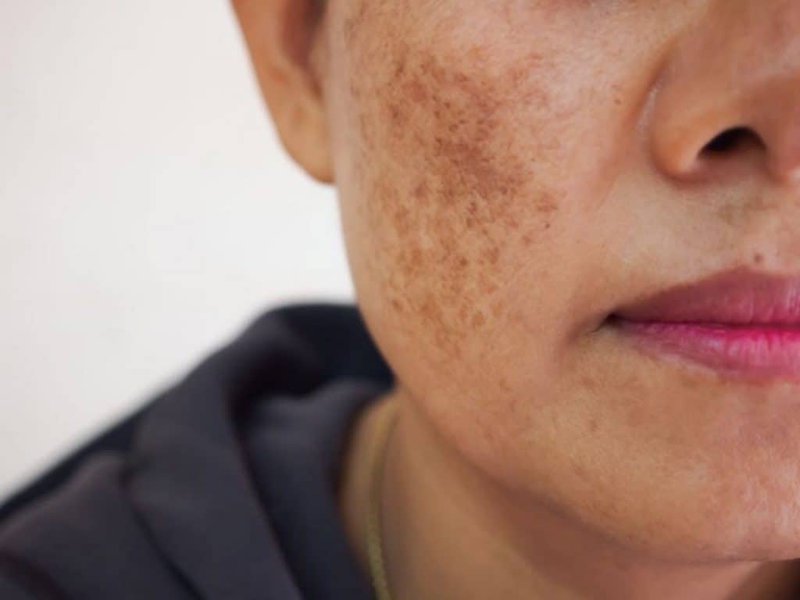 Giải pháp cải thiện nám da mặt an toàn, hiệu quả từ bộ đôi sản phẩm thảo dược - Ảnh 1.
