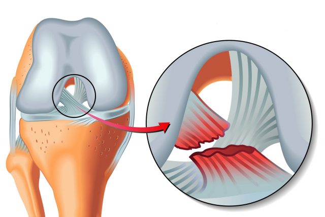 Không tập thể dục, không chơi thể thao, nhưng nhóm phụ nữ này lại dễ bị rách dây chằng đầu gối gấp 8 lần nam giới - Ảnh 1.