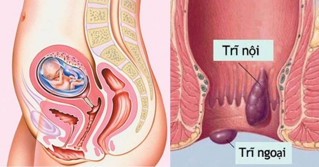 Bệnh trĩ ở bà bầu ảnh hưởng như nào tới mẹ và con? - Ảnh 2.