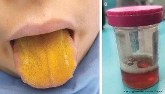 Bác sĩ cũng sốc khi thấy lưỡi cậu bé 12 tuổi chuyển thành màu vàng, nước tiểu sẫm màu - Ảnh 1.