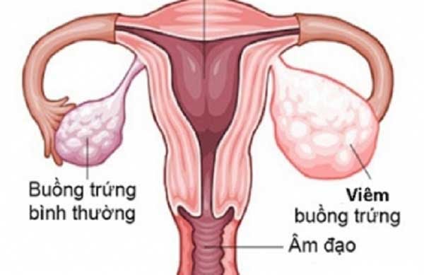 Tại sao buồng trứng bị viêm? - Ảnh 1.