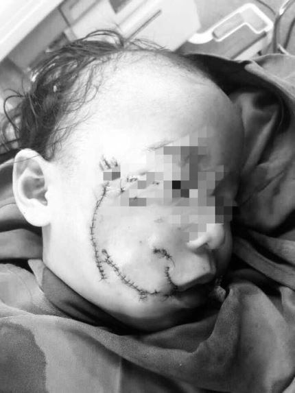 Nghệ An: Bé 3 tuổi bị chó nhà cắn với nhiều thương tích ở vùng mặt - Ảnh 1.