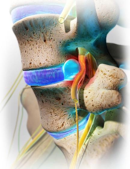 Giải pháp cải thiện thoát vị đĩa đệm thắt lưng từ tự nhiên – Xu hướng mới được nhiều người lựa chọn - Ảnh 1.