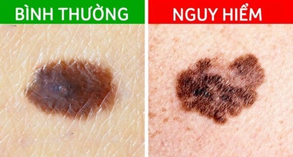 Các dấu hiệu cảnh báo ung thư đang xảy ra trên nốt ruồi trước đây ...