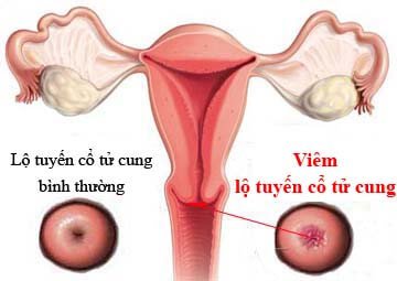 Viêm lộ tuyến cổ tử cung - bệnh phụ khoa không thể chủ quan - Ảnh 1.