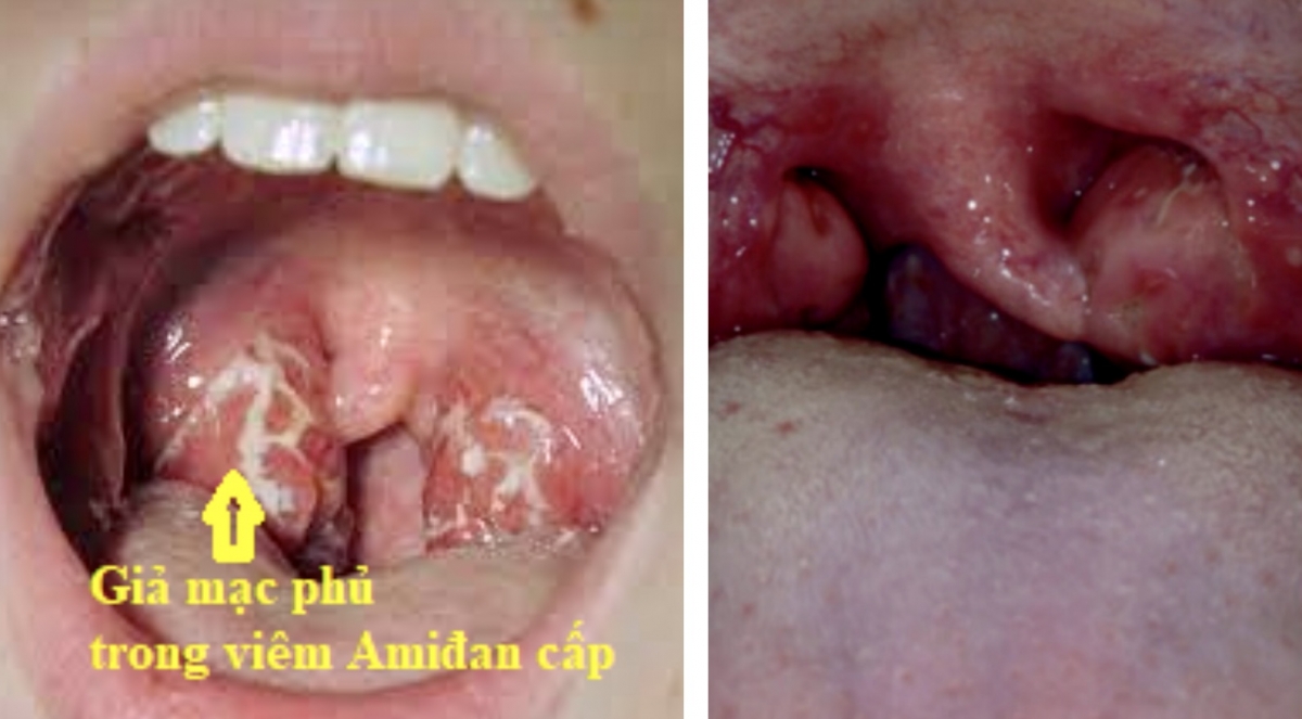 Nổi cục màu trắng trong miệng là bệnh gì Cách điều trị ra sao