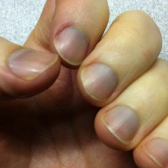 6 Dấu hiệu cảnh b&aacute;o bạn c&oacute; thể đang mắc căn bệnh h&ocirc; hấp nguy hiểm, chớ chủ quan bỏ qua - Ảnh 5.