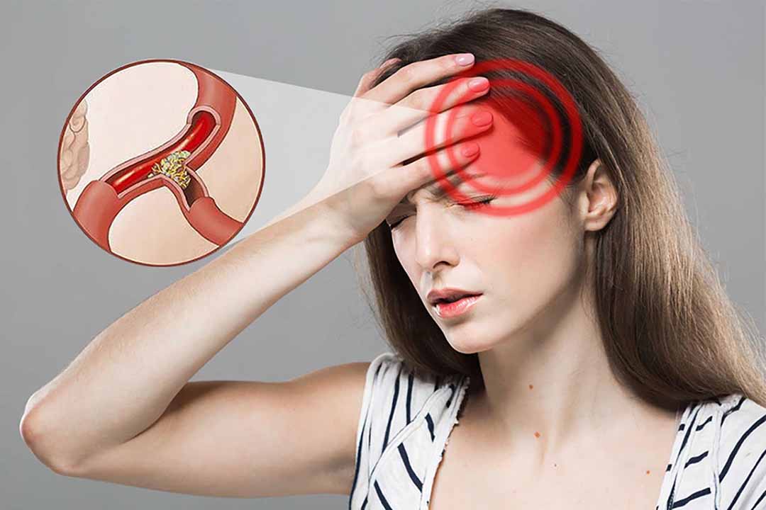 Khi máu cung cấp lên não không đủ cơ thể sẽ có 3 biểu hiện, phát hiện sớm sẽ tránh xa được tai biến mạch máu não - Ảnh 5.