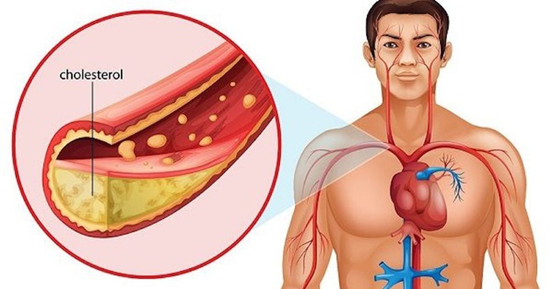 Sự thật về loại chất béo xấu nhất có trong nhiều món ăn ngon nhưng gây hại cho cơ thể - Ảnh 2.