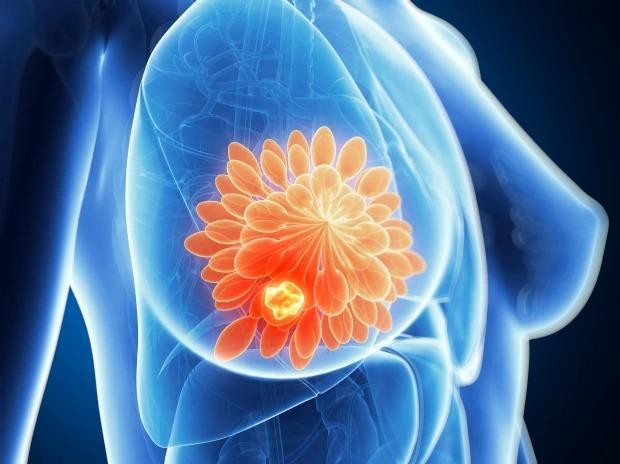 Kích thước vòng một và những lầm tưởng phổ biến về ung thư vú