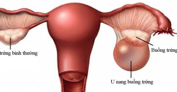Chuyên gia cảnh báo phụ nữ mang thai không nên chủ quan với u buồng trứng