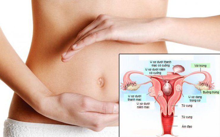 Phát hiện u xơ tử cung, chị em cần làm gì để ngăn ngừa biến chứng