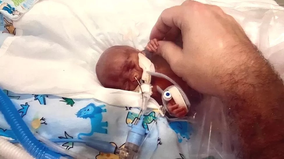Em bé đón sinh nhật đầu tiên sau chẩn đoán chỉ sống được một ngày - Ảnh 2.