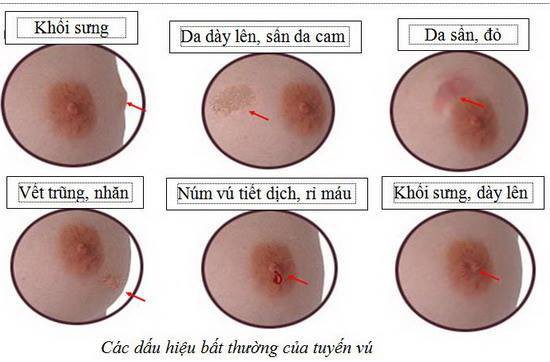 Bác sĩ cảnh báo về &quot;điểm mù&quot; trong kiểm tra ung thư vú tại nhà thường bị bỏ qua - Ảnh 4.